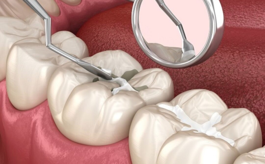 Герметизація фісур: простий спосіб зберегти зуби