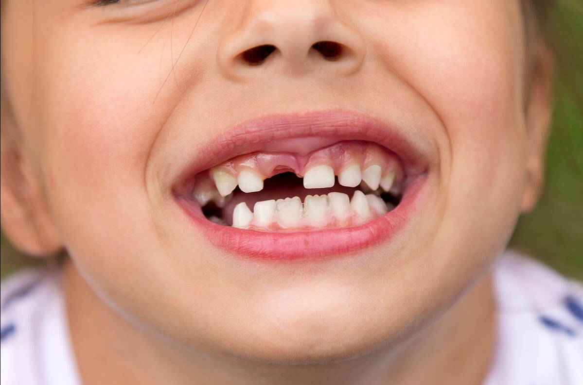Чи можна вирвати молочний зуб в домашніх умовах